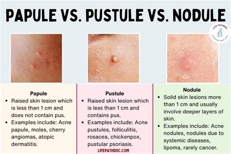 papule perlée|Papules perlées : que faut